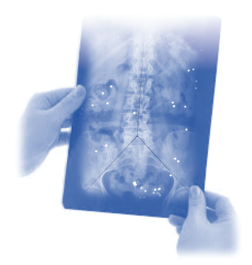 Radiographie abdominale mettant en évidence les marqueurs radio-opaques sous forme de points blancs sur le cliché.